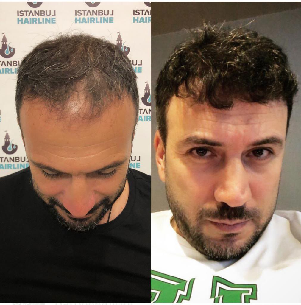 Spor dünyasında saç ekim akımı